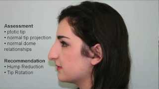 Tip Rotation amp Hump Reduction Rhinoplasty Case Study  Dr Buonassisi 8 West Clinic in Vancouver [upl. by Disharoon503]