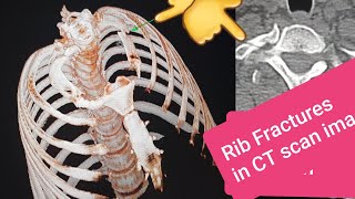 fracture FRACTURED RIB ON CT SCAN [upl. by Curtis]