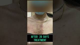 Best Back Acne Treatment in Punjab  Is Back Acne curable Dr Ashima Goel PARISA skin clinic [upl. by Auod336]