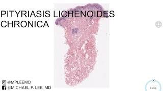 Pityriasis Lichenoides Chronica Dermpath Made Easy [upl. by Harobed317]