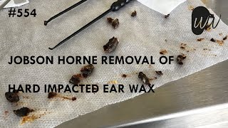 554  Jobson Horne Removal of Hard Impacted Ear Wax [upl. by Balliol]