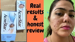 Acnestar Gel amp Acnestar soap Review amp results HOW TO GET RID OF ACNE FAST Pimples blackheads [upl. by Dace]