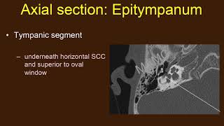 TMT HFN by Dr Jyoti Kumar  Temporal Bone Anatomy Part I [upl. by Zinah]