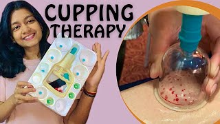 CUPPING THERAPY BENEFITS  PRACTICAL  THEORY [upl. by Martinez523]