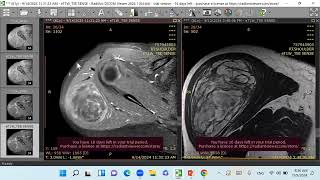 Liposarcoma [upl. by Edualc]