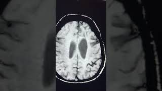 Significance of SWI  Superficial siderosis [upl. by Attiuqahs]