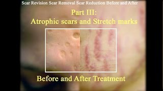 Part III Atrophic and acne scars and Stretch marks before after treatment [upl. by Spring]