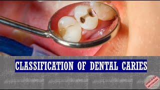 Classification of Dental Caries [upl. by Phillada]