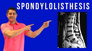 Spondylolisthesis Cause Symptoms and treatment for pain relief [upl. by Aiciled642]