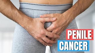 Dr Piyush Agarwal on Recognizing Diagnosing and Treating Penile Cancer [upl. by Sergent]