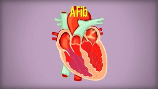 Living with Atrial Fibrillation AFib [upl. by Neenaej]