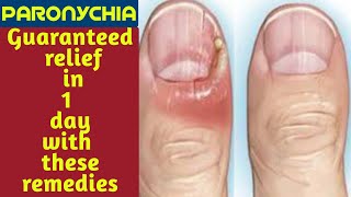 Paronychia finger home remedies  Paronychia fungal nail infection  Paronychia nail home remedies [upl. by Shwalb]