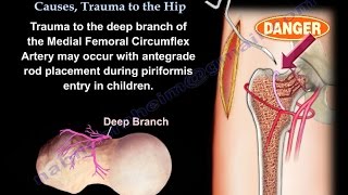 AVN Femoral Head Causes Trauma To The Hip  Everything You Need To Know  Dr Nabil Ebraheim [upl. by Angadreme654]