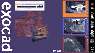 exocad Video Tutorial exoplan [upl. by Analed]