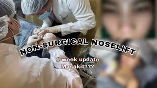 MY EXPERIENCE OF NONSURGICAL NOSELIFT namaga [upl. by Ateuqahs134]