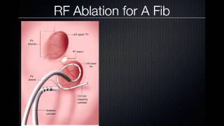 Pulmonary Vein Ablation Cardiac CT [upl. by Anyat148]