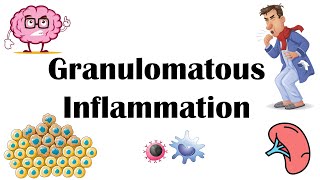 Granulomatous Inflammation  Types Pathophysiology Different Cell Types In Granuloma amp Examples [upl. by Reppiks]