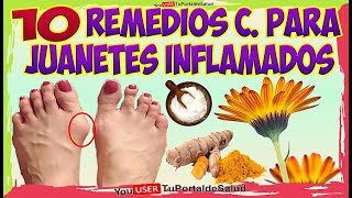 COMO ELIMINAR LOS JUANETES con Estos 10 Remedios Caseros Para los JUANETES INFLAMADOS [upl. by Noterb]