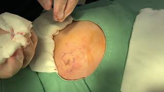 粉瘤くりぬき法 20代女性おしりepidermal cyst atheroma cystic acne extractions 脂肪腫 lipoma クリニーク大阪心斎橋 大阪梅田院 名古屋院 福岡院 [upl. by Ubald]