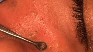 THE MOST VIEWA FACE FULL OF BLACKHEADS SATISFYING VIDEO 3 [upl. by Gottfried]