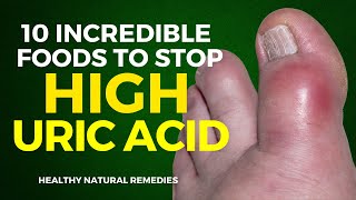 10 Incredible Foods To Stop High Uric Acid [upl. by Trey]