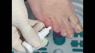 Fungal nail treatment Treatment drops shown in the end [upl. by Barbaresi3]