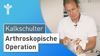 Kalkschulter OP  So wird die Ursache der Schulterschmerzen durch die Schulterarthroskopie beseitigt [upl. by Latyrc]