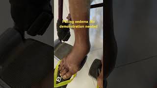 Pitting Edema in Action A Clear SelfDemo [upl. by Grey]