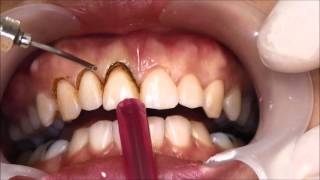 ตัดเหงือก แก้ยิ้มเห็นเหงือก  Gummy Smile Treatment by Gingivectomy [upl. by Burkhard]