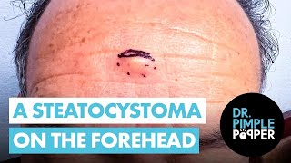 A Forehead Steatocystoma with a BONUS  Dr Pimple Popper [upl. by Niccolo]