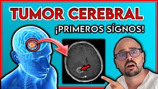 ¡ESTOS son TODOS los SÍNTOMAS de un TUMOR CEREBRAL  ¡SIGNOS de ALERTA [upl. by Atnuahsal]