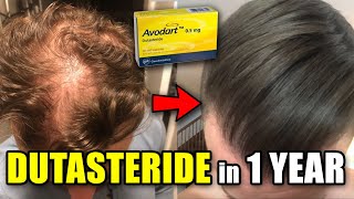 CRAZY Dutasteride Hair Loss REVERSAL In Only 1 Year [upl. by Natsreik885]