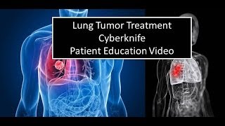 Lung Cancer Treatment  Cyberknife  Pasadena Cyberknife [upl. by Karlene918]