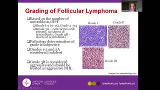 Follicular Lymphoma and other Indolent Lymphomas [upl. by Cynthia]