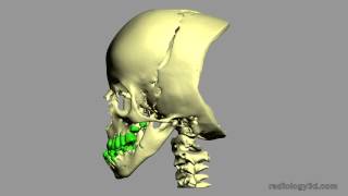 Malposizione Dentale Tooth Malposition [upl. by Deeraf785]