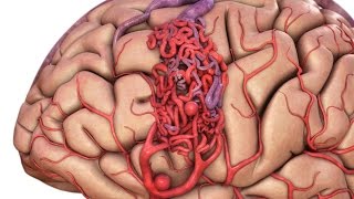 Лечение АртериоВенозной Мальформации Treatment of Arteriovenous Malformations ARUBA [upl. by Odlauso]