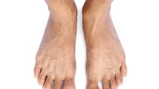 How to Know If You Have Mallet Toes  Foot Care [upl. by Ilahtan778]