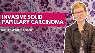 What is Invasive Solid Papillary Carcinoma and How is it Treated [upl. by Aiello]