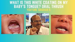 Oral Thrush in babies White coating on tongue thrush oralthrush whitecoating [upl. by Eeliab]