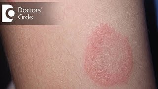 How to manage Chronic Ringworm infection  Dr Rajdeep Mysore [upl. by Ajssatan251]