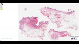 Gallbladder Acute on chronic cholecystitis Microscopy  Talking Slide [upl. by Domini]