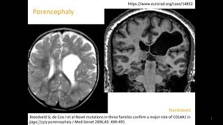 10 Schizencephaly porencephaly COL4A1 mutation congenital CMV open lip closed lip birth defect [upl. by Neerahs]