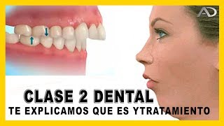 👉Maloclusion dental  𝙈𝙤𝙧𝙙𝙞𝙙𝙖 𝘾𝙡𝙖𝙨𝙚 𝙄𝙄 dental en Ortodoncia  que es y como corregirla [upl. by Hteik]