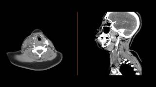 Internal jugular thrombophlebitis [upl. by Eitirahc]