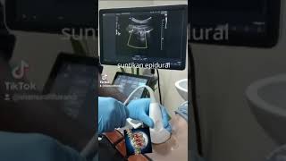 Transforaminal epidural injection for slipped disc patient ultrasound [upl. by Aivatnwahs432]