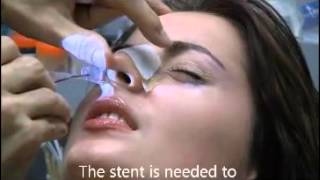 Removing a Nasal Stent on the 7th Day After Rhinoplasty [upl. by Attelrahc297]