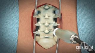 Lumbar Discectomy Surgery Medical Animation [upl. by Nnylacissej]