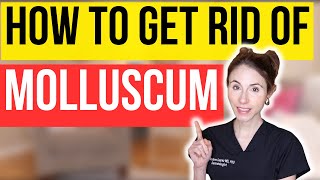 How To Get Rid Of Molluscum FAST  Dermatologist Tips [upl. by Aztiram]