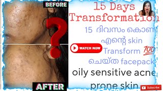 ✅15 Days Skin Transformation Videoskintransformers skintransformation skintransformationchallenge [upl. by Ahsinyd888]