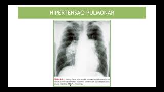 Síndromes Cardiovasculares PARTE 3 [upl. by Kirch]